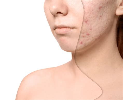 Acne And Scars