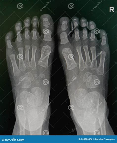 X Ray Image Both Foot Ap View Show Normal Pediatric Bone Stock Photo