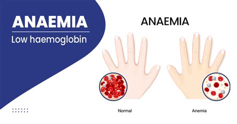 Anemia Symptoms Causes Diagnosis And Treatment Max Lab