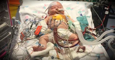 Doctors Stopped This Miracle Baby S Heart For Hours During Surgery