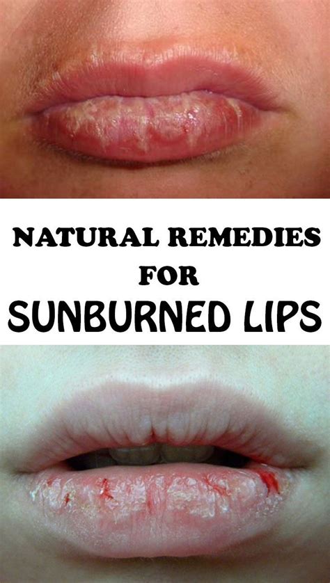 Natural Remedies For Sunburned Lips Sunburned Lips Sunburn Blister