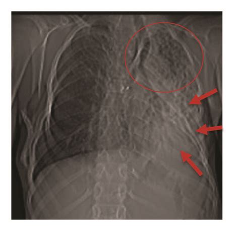 Frontal Chest X Ray Showing An Atelectasis Of The Left Lower Lobe Red