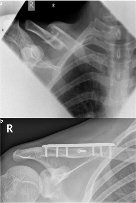 Functional Outcomes Of Clavicular Fractures Fixation In Adolescent