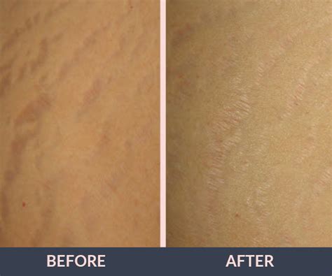 Scar Removal Spider Veins Stretch Marks Vina Laser Med Spa