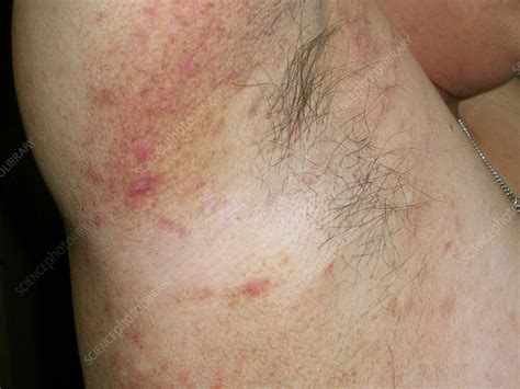 Pityriasis Lichenoides Chronica Stock Image C0562613 Science