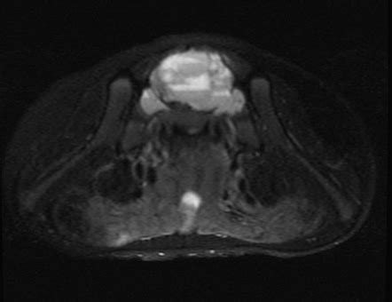 Aneurysmal Bone Cyst Sacrum Radiology Case Radiopaedia Org