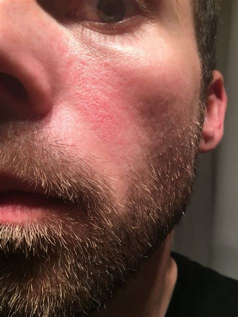 Skin Concerns Red Patchy Area Above Cheeks Had It For Over A Year