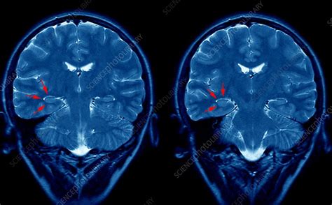 Epilepsy Brain Mri Scan Stock Image C0030931 Science Photo