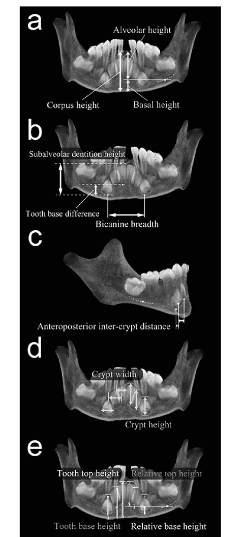 Mandibular Metrics In Frontal A B D E And Lateral C Ct Image