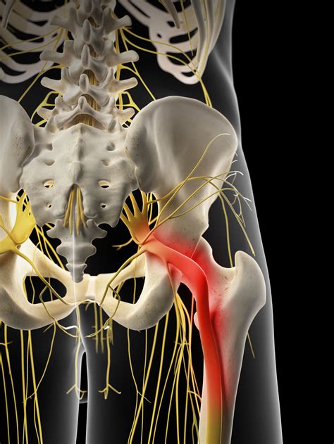 Sciatica Pain Relief Anatomy And Definition — Revive Sport And Spine