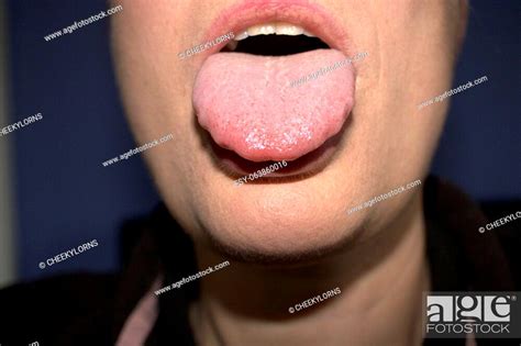 swollen enlarged white tongue with wavy ripple scalloped edges medical name is macroglossia