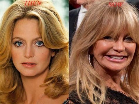 Goldie Hawn Before And After Plastic Surgery Celebrity Plastic Surgery Online