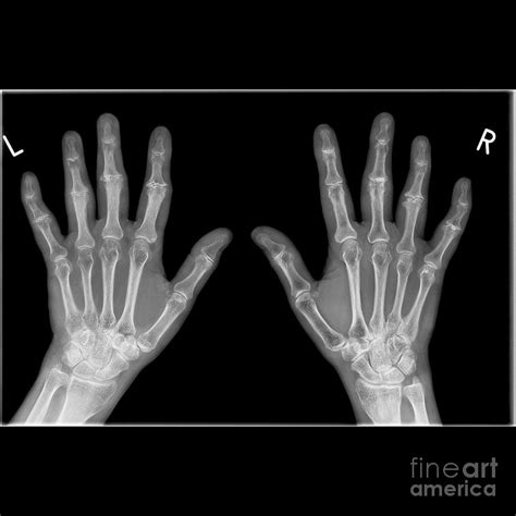 Arthritic Hands X Ray Photograph By Science Photo Library Pixels