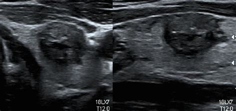 43 Thyroid Cancer Ultrasound