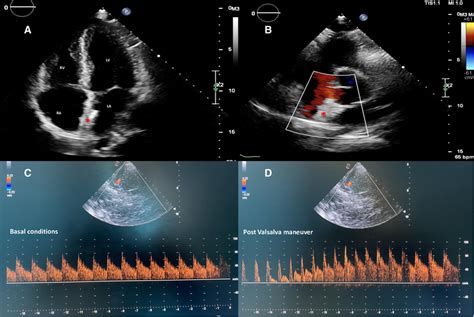 Two Dimensional Tte Color Doppler In Apical Four Chambers A And
