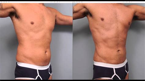 The Benefits Of Liposuction For Men Dr Sterry Explains Youtube