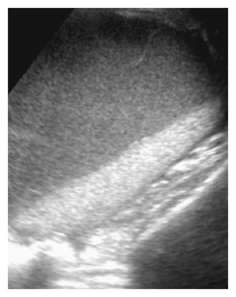 A Ultrasound Demonstrating A Complex Cystic Mass In The Left Adnexa