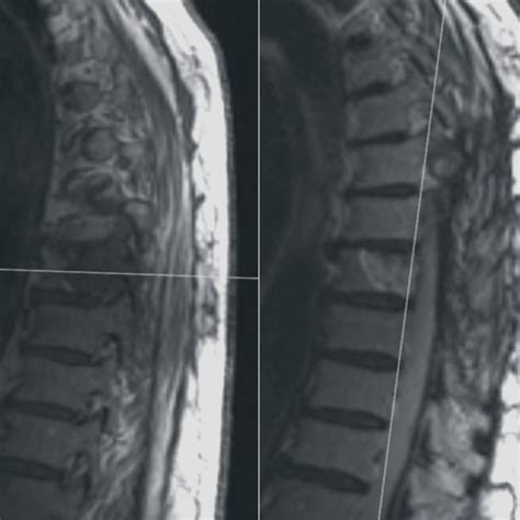 Spinal Mri Left Epidural Thoracic Tumor T7 T9 Infiltrating The Left