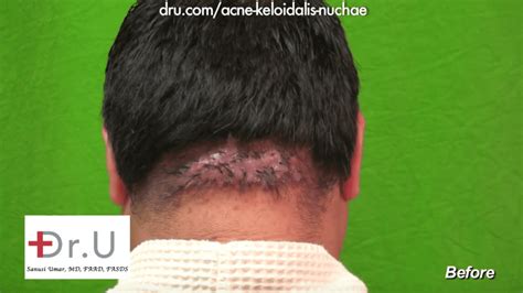 Dr U Clinic Akn Razor Bump Surgical Cure Results In Los Angeles