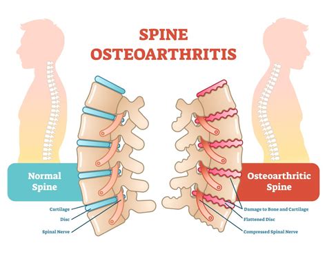 How A Patient S Age Affects Spinal Surgery For Back Pain New Jersey