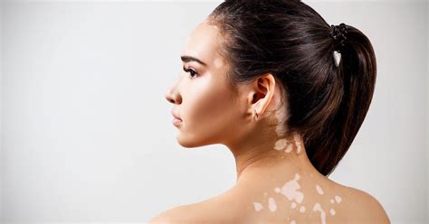 Vitiligo Treatment In Istanbul Turkey Best Clinics And Prices 2024 2024