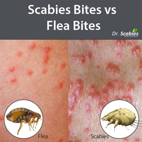 Flea Bed Bug Bites Scabies