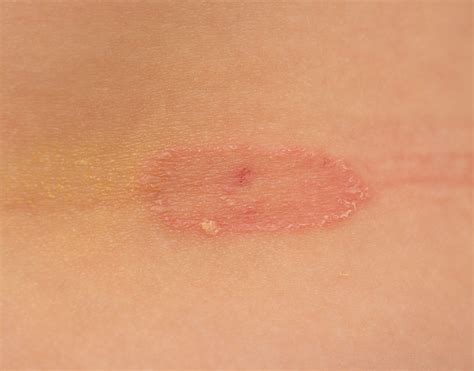 Common Fungal Infections Ringworm Epiphany Dermatology