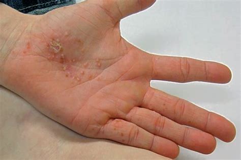 Eczema Pictures 2 Allergy Medik