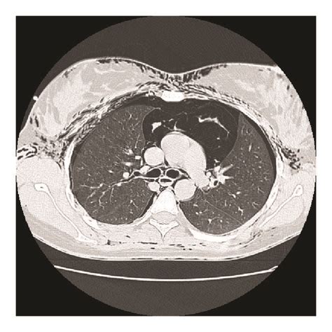 Thoracic Computed Tomography Showing Pneumomediastinum Subcutaneous Download Scientific