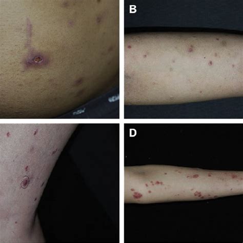 A Clinical Pictures Of Patient 15ddiscrete Erythematous To Violaceous
