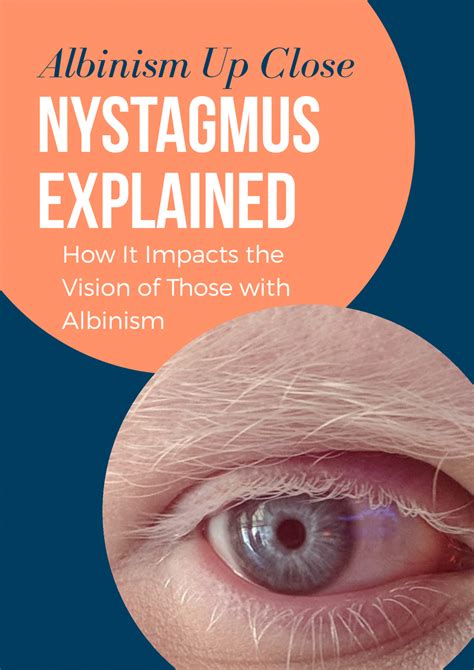Nystagmus Explained How It Impacts The Vision Of Those With Albinism
