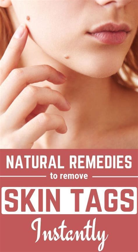 how to get rid of skin tags naturally with images skin tag removal skin tag home remedies