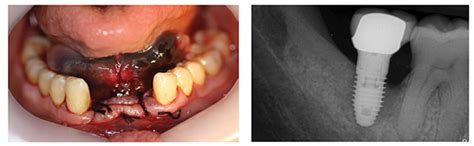 Implant Ce Article Evaluation And Management Of Common Dental Implant