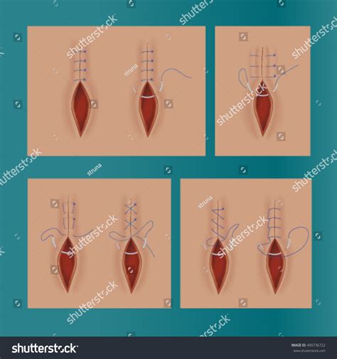 Surgical Stitches Types Sutures Stock Vector 490736722 Shutterstock