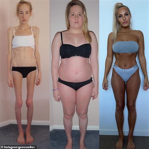 Anorexia Survivor Whose Weight Plummeted To Just Kilos Shares