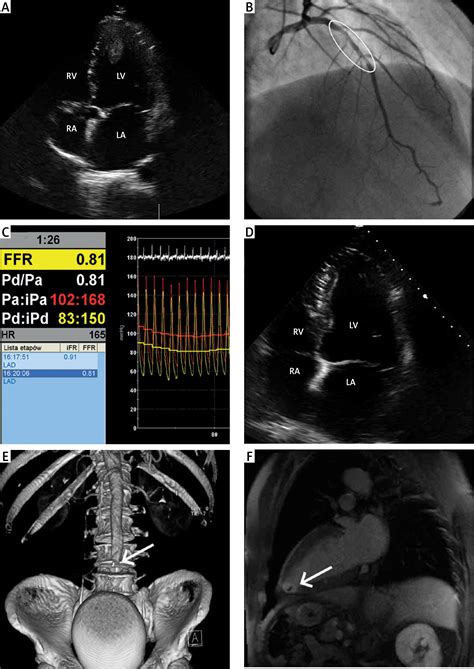 Occlusion Of The Abdominal Aorta During Coronary Angiography With