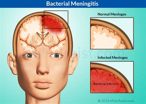 Bacterial Meningitis Causes Risk Factors Symptoms Diagnosis Treatment Antibiotics