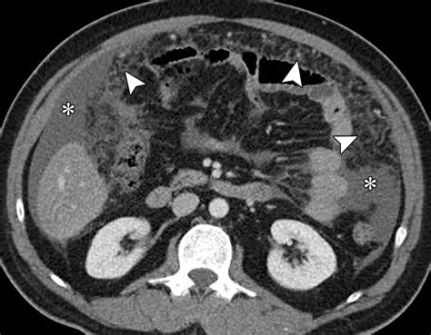 Ligaments And Lymphatic Pathways In Gastric Adenocarcinoma Radiographics