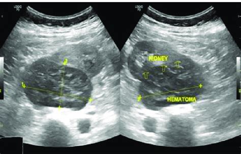 Ultrasound Pictures Showing The Right Kidney With Perirenal Hematoma