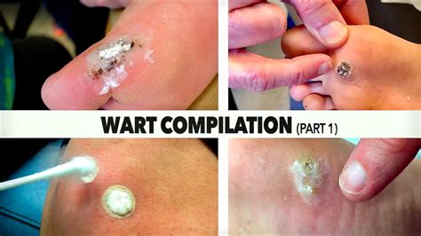 Wart Burning Compilation Part 14 Dr Paul Youtube