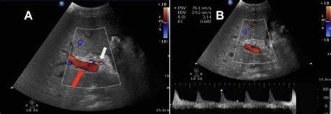 Ceus Shows Hepatic Artery Perfusion After Liver Transplant Helping