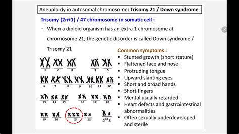 73 I Aneuploidyautosomal Chromosometrisomy 21down Syndrome Youtube