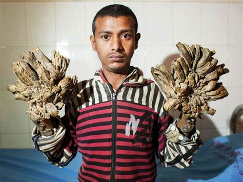Bangladesh ‘tree Man Returns To Hospital As Condition Worsens Asia