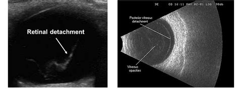 Posterior Vitreous Detachment Ultrasound