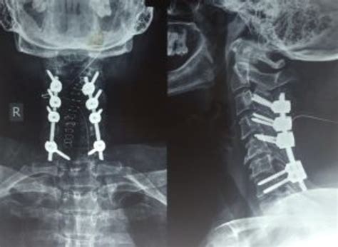 Posterior Cervical Laminectomy And Fusion At Dr Sanjay N Patil Spine