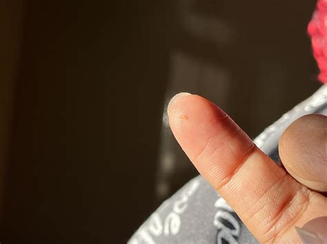 I popped a pimple on my cheek and this came out : r/IndianSkincareAddicts
