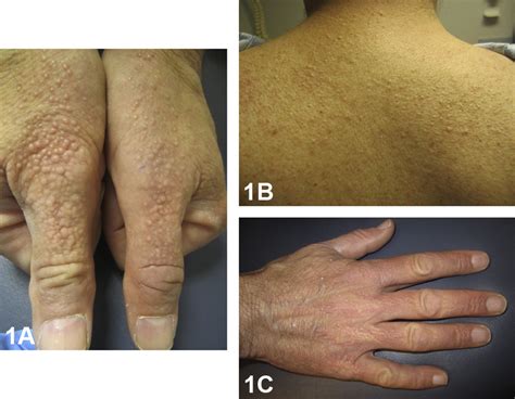 Painless Papules On The Hands Journal Of The American Academy Of