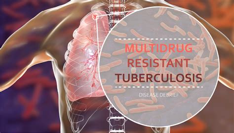 multidrug resistant tuberculosis national collaborating centre for infectious diseases