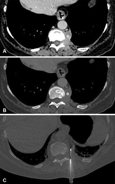 A B Axial Unenhanced Ct Images With Soft Tissue A And Bone B