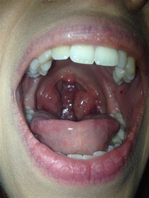 My 21 Year Old Daughter Has Experienced Very Swollen Tonsils